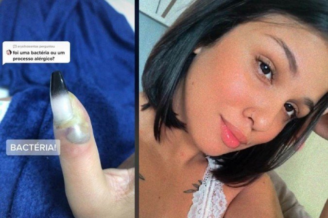  Mulher perde a ponta do dedo após colocar unha de acrigel e relata drama na internet