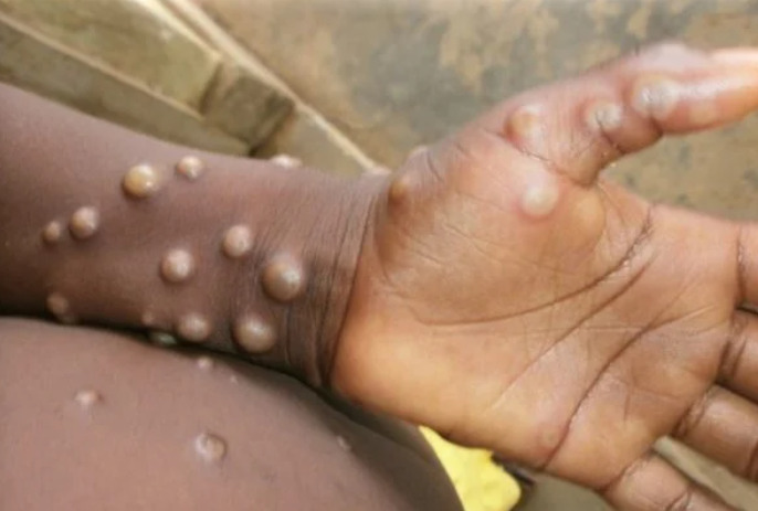  Varíola dos macacos é identificada em crianças pela primeira vez